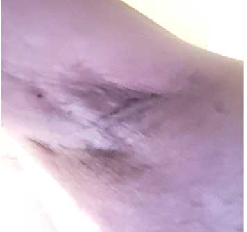 LEFT ARMPIT SEPT 14